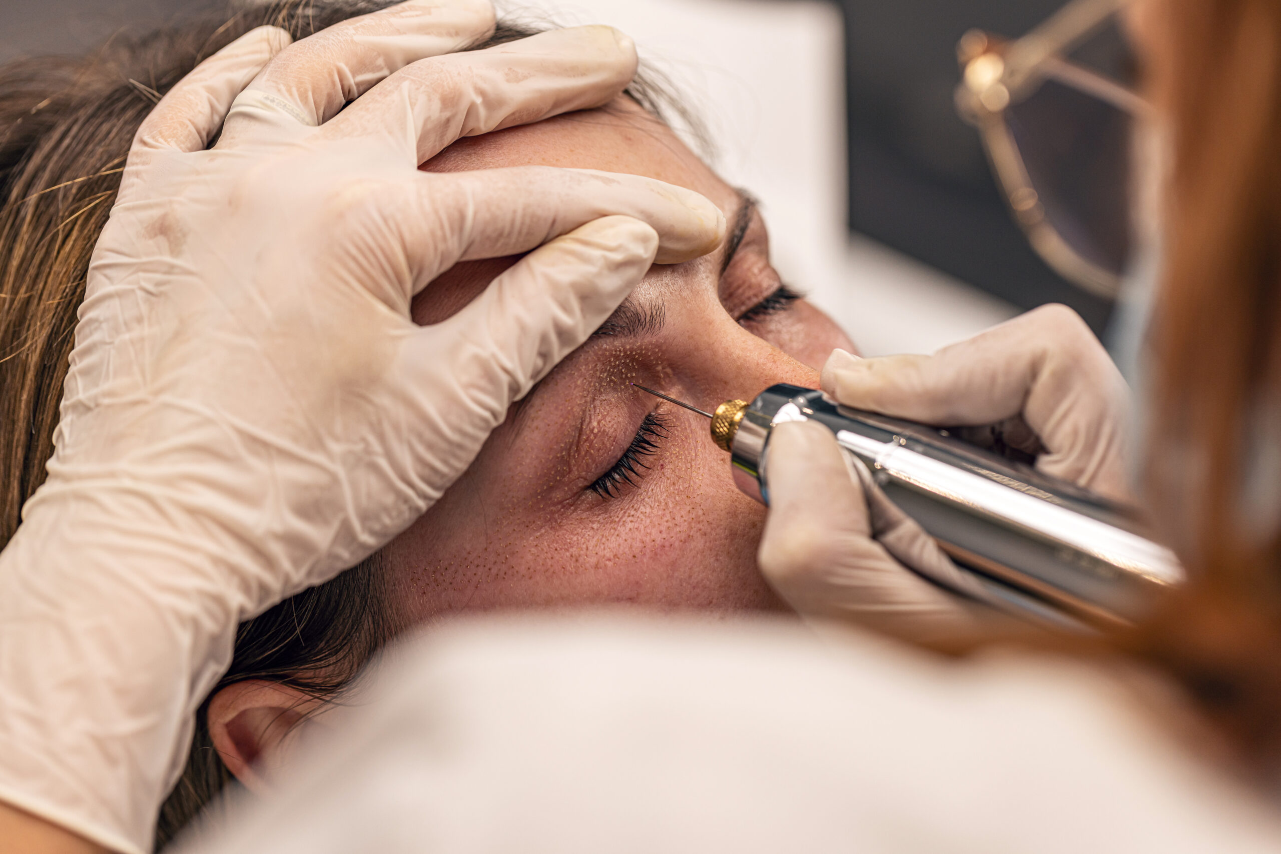 Aesthetic specialist performing Plasma Fibroblast Treatment in Orem at Bright Beauty Medspa.
